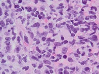 Blastic Plasmacytoid Dendritic Cell Neoplasm 7