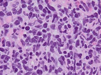 Blastic Plasmacytoid Dendritic Cell Neoplasm 8