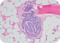 Hydrophilic polymer embolus in the bone marrow