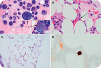 Unexpected parvovirus B19 infection in a patient with multiple myeloma