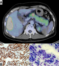 Hepatic Plasmacytoma