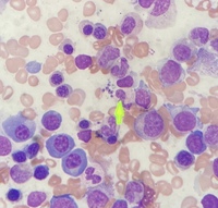 Leishmania amastigotes in the bone marrow 1