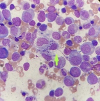 Leishmania amastigotes in the bone marrow 2