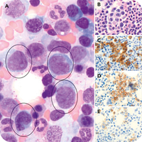 Cerebriform cells in a bone marrow specimen