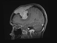 MRI Brain