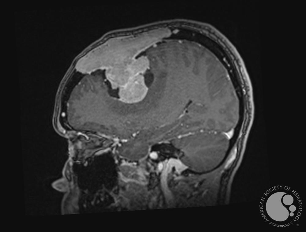 MRI Brain