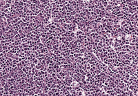 Tumor Biopsy 1