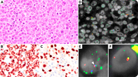 FISH for EBV genome in a patient with diffuse large B-cell lymphoma harboring t(14;18)(q32;q21)