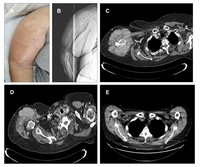 Unveiling Multiple Myeloma Through a Bulky Humerus Plasmacytoma