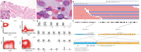 Acute leukemia with predominantly myeloid differentiation and TBL1XR1::CSF1R fusion