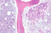 SCC in Bone Marrow 2