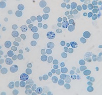 Hemoglobin H disease (HbH) 2