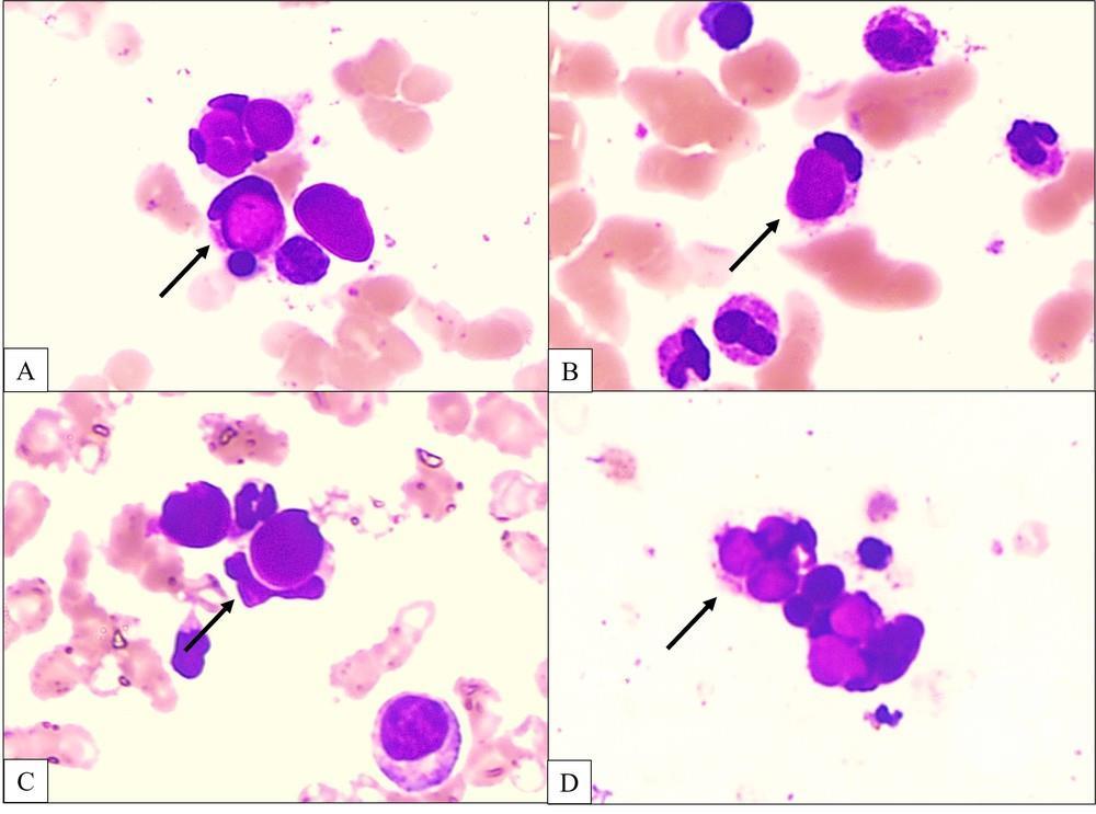 LE cells in the marrow – A subtle indicator of systemic lupus erythematosus in a clinically unforeseen case