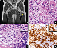 Masqueraded mastocytosis with prominent crystal-storing histiocytic infiltration