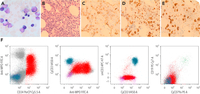 T/myeloid MPAL with biallelic CEBPA mutations