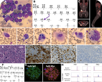 Two sides of the same coin: transdifferentiation from Burkitt lymphoma to histiocytic sarcoma