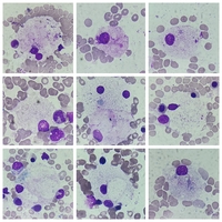 foam cell in Niemann-Pick patient