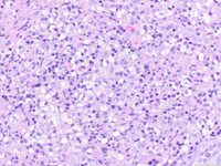 ALCL, lymphohistiocytic variant