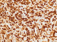 ALCL, lymphohistiocytic variant, CD30 IHC