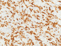 ALCL, lymphohistiocytic variant, CD163 IHC