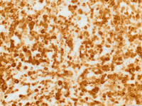 ALCL, lymphohistiocytic variant, ALK IHC