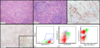 Castleman disease with modest T-lymphoblastic proliferation