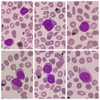 Splenic B-cell Lymphoma/Leukaemia with Prominent Nucleoli (SBLPN)