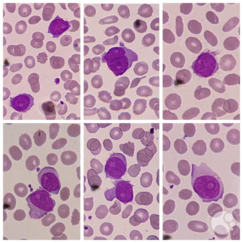 Splenic B-cell Lymphoma/Leukaemia with Prominent Nucleoli (SBLPN)