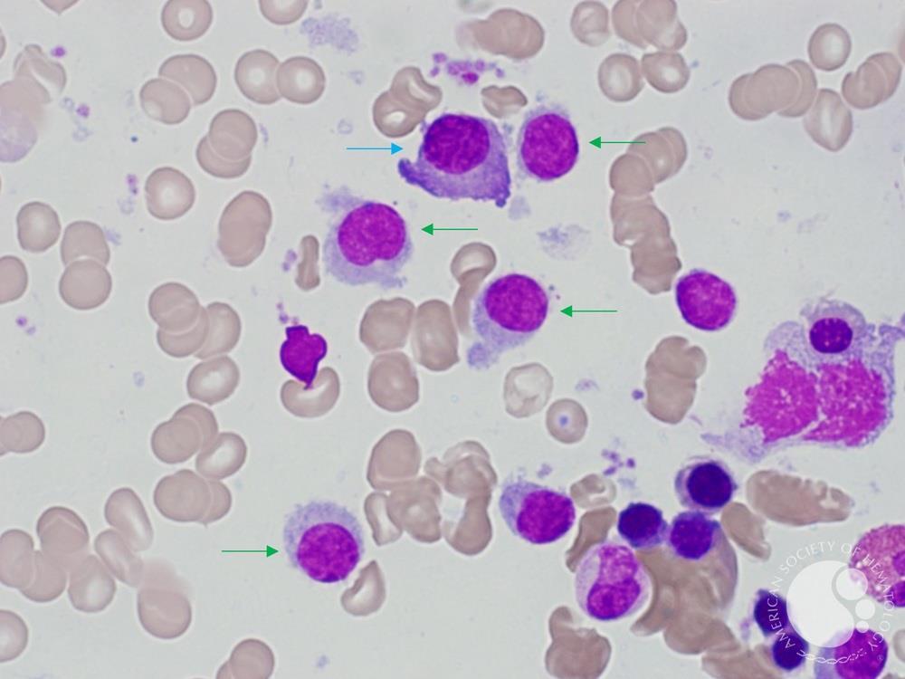 Hairy Cell Leukaemia and Multiple Myeloma 1