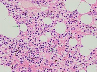 Hairy Cell Leukaemia and Multiple Myeloma 2