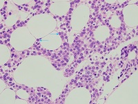 Hairy Cell Leukaemia and Multiple Myeloma 3
