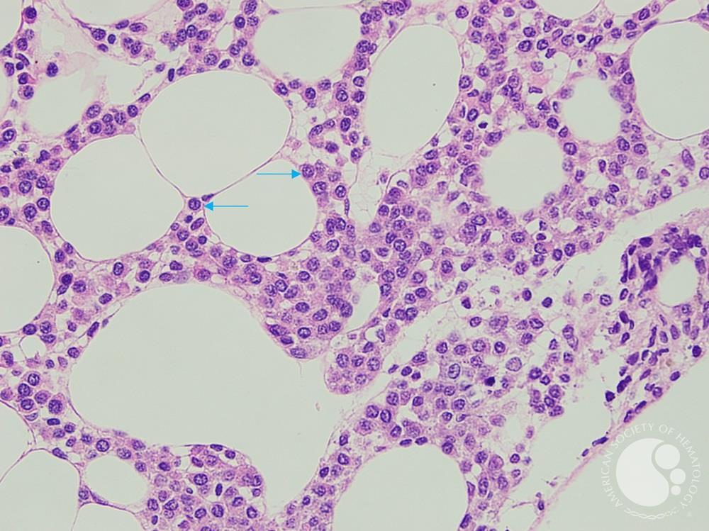 Hairy Cell Leukaemia and Multiple Myeloma 3