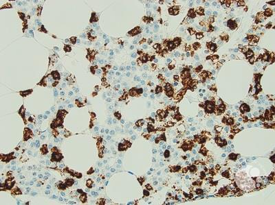 Hairy Cell Leukaemia and Multiple Myeloma 4