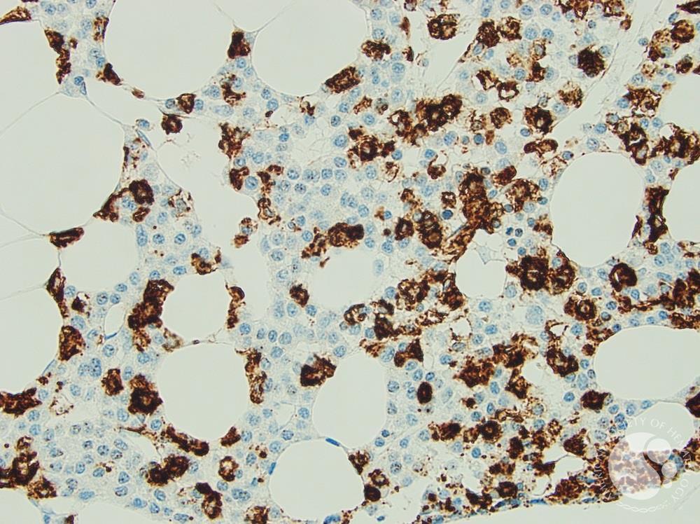 Hairy Cell Leukaemia and Multiple Myeloma 4