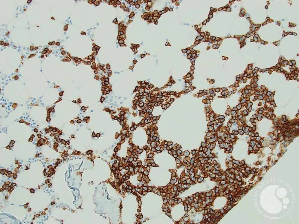 Hairy Cell Leukaemia and Multiple Myeloma 5
