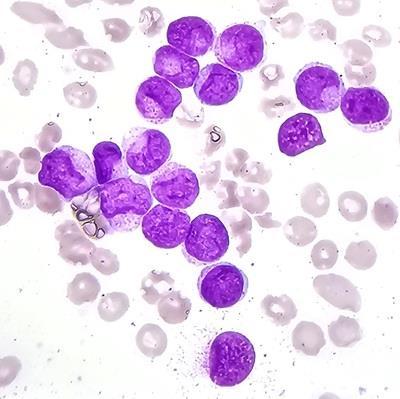 Acute myeloid leukemia with Cup-like blasts 1