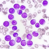 Acute myeloid leukemia with Cup-like blasts 2