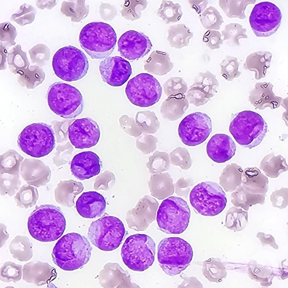Acute myeloid leukemia with Cup-like blasts 2