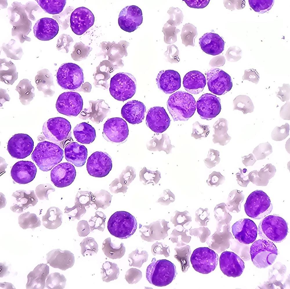 Acute myeloid leukemia with Cup-like blasts 3