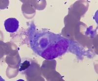 Hemophagocytosis figures following CART Cell Therapy 1