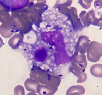 Hemophagocytosis figures following CART Cell Therapy 2