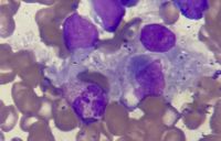 Hemophagocytosis figures following CART Cell Therapy 3