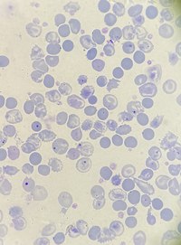 beta-thalassemia major