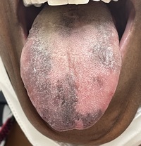 Hydroxyurea-associated hyperpigmentation of tongue in sickle cell anemia