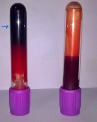 Figure 2. EDTA vacutainer showing immediate clotting of patient sample due to Cryoglobulenemia in a case of Lymphoplasmacytic Lymphoma