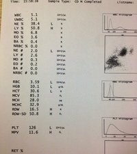 EDTA vacutainer showing immediate clotting of the sample , not allowing the sample to be tilted for mixing with the anticoagulant. Normal control sample is also depicted in the picture. 2