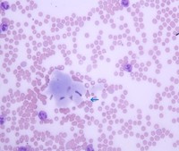 Figure 5. Peripheral smear 40X, Leishman Stain showing pale blue deposits of cryoglobulins in the body of the smear