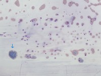 Figure 6. Peripheral smear 10X, Leishman Stain showing multiple pale blue deposits of cryoglobulins in the tail end of the smear