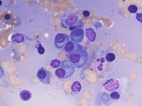 Multiple bluish globules indicative of cryoglobulinemia visible at the tail end of the smear.