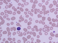 Peripheral smear 100X, Leishman Stain showing multiple acanthocytes